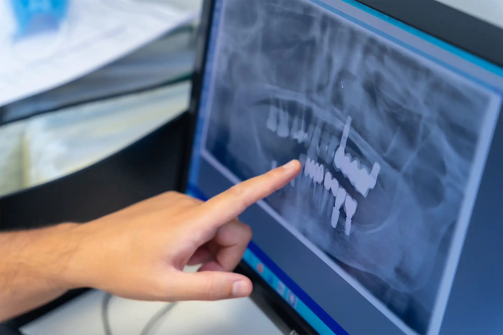 Radiografia su monitor che mostra i risultati di implantologia dentale effettuata nello studio odontoiatrico Maurizio Giussani a Milano