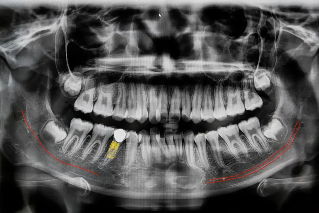 Radiografia dentale realizzata presso lo studio odontoiatrico Maurizio Giussani a Milano